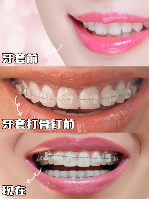 成人矫正牙齿的利与弊知乎_成人牙齿矫正_成人矫正牙齿的效果