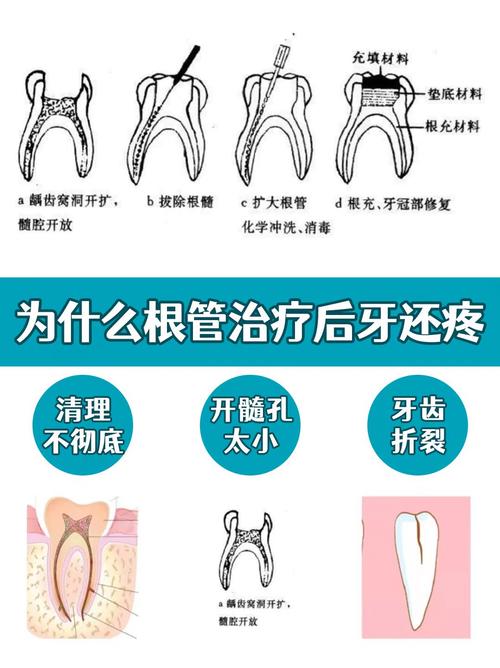 根管治疗种牙区别_牙根治疗管种是怎么做的_根管治疗是种牙吗