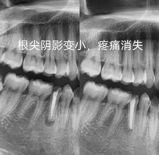 根管治疗是种牙吗_根管治疗种牙区别_牙根治疗管种是怎么做的