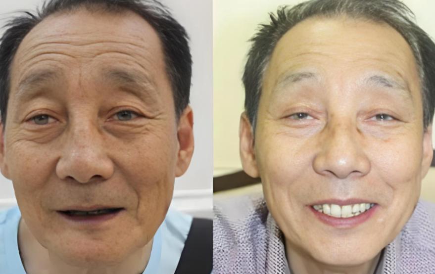 活动义齿与种植牙利敝_40岁种牙还是活动义齿_活动义齿种牙