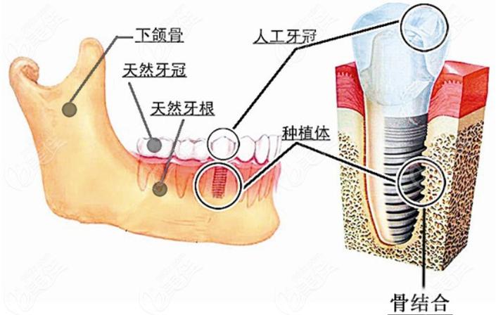 瑞士种植牙骨水平_深圳瑞士ITI种植牙适合什么牙槽骨_牙槽骨种植怎么收费