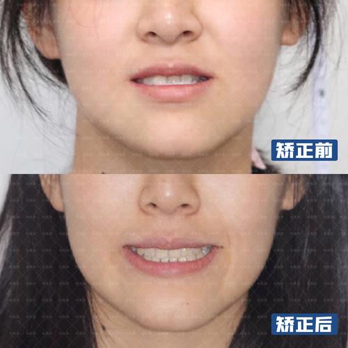 牙齿矫正最好在几岁_6岁孩子牙齿矫正最佳年龄_牙齿矫正年龄最佳孩子是多少岁