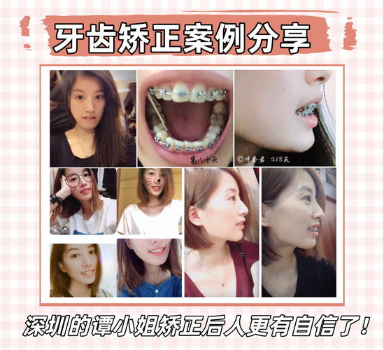 深圳正畸价格_深圳福田成人地包天正畸医院_深圳医院正畸多少钱