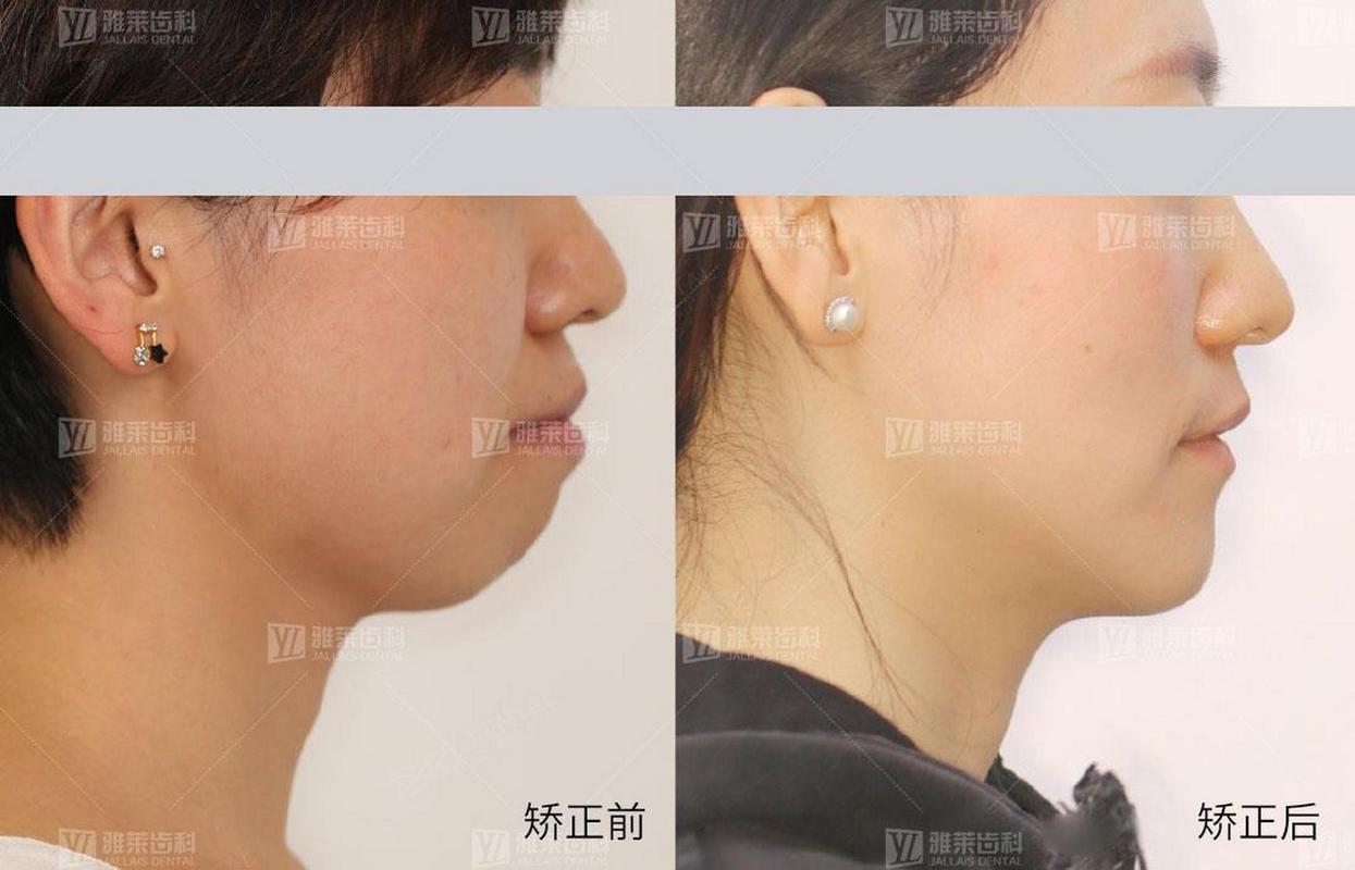 矫正牙齿改变脸型对比_矫正牙齿对脸型的改变_矫正牙齿脸型有变化吗