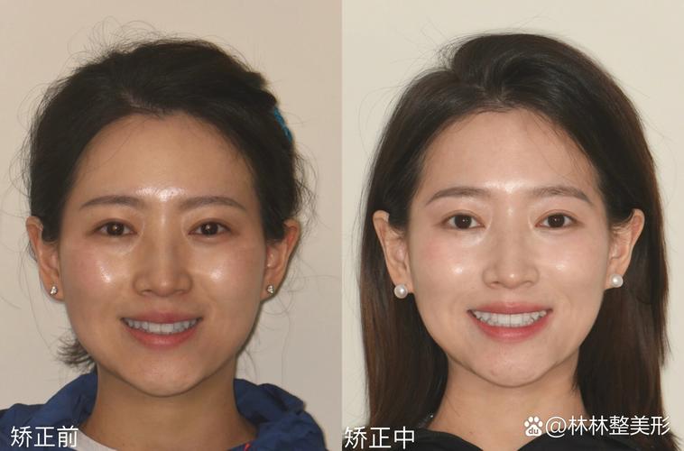 矫正牙齿对脸型的改变_矫正牙齿改变脸型对比_矫正牙齿脸型有变化吗