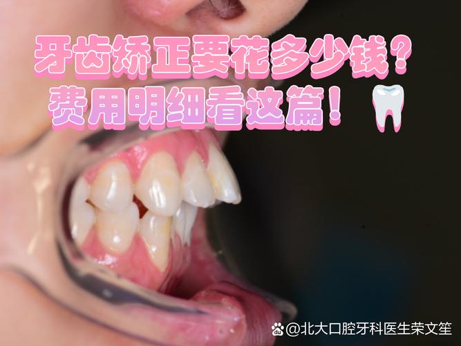广州牙齿矫正到底要花多少钱?看完这篇不踩坑