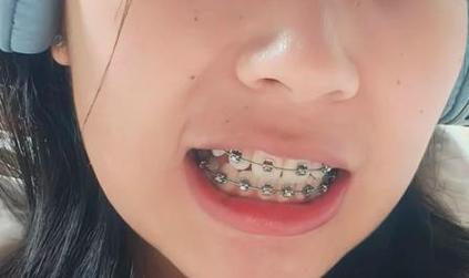 牙齿矫正广州哪个医院好_广州矫正牙齿一般要花多少钱_广州牙齿矫正多少钱