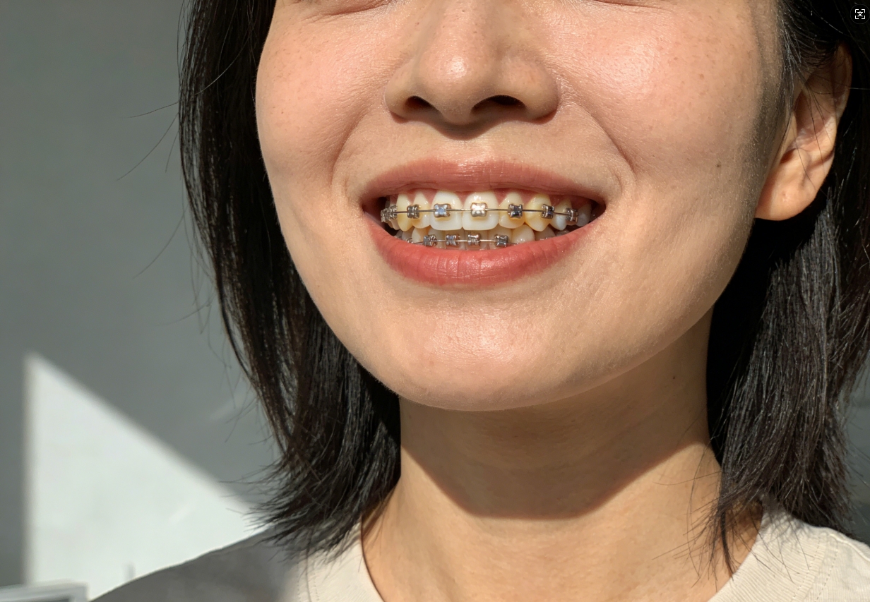 半口种牙选什么材料好?医生详解纯钛、全瓷优劣,帮你省心做决定