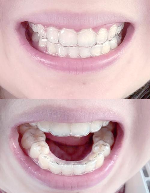 牙齿矫正后保持器要戴多久？详解佩戴周期与重要性