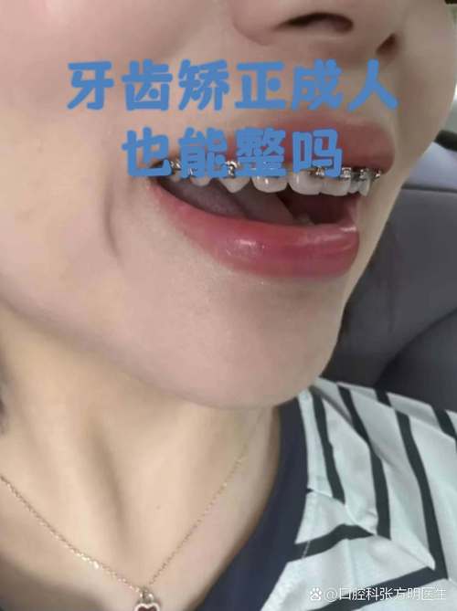 成人地包天牙齿矫正_成人地包天牙齿矫正价格_成人地包天牙齿矫正有效果吗