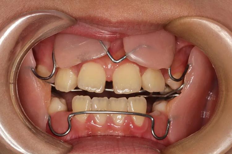 成人地包天牙齿矫正有效果吗_成人地包天牙齿矫正价格_成人地包天牙齿矫正