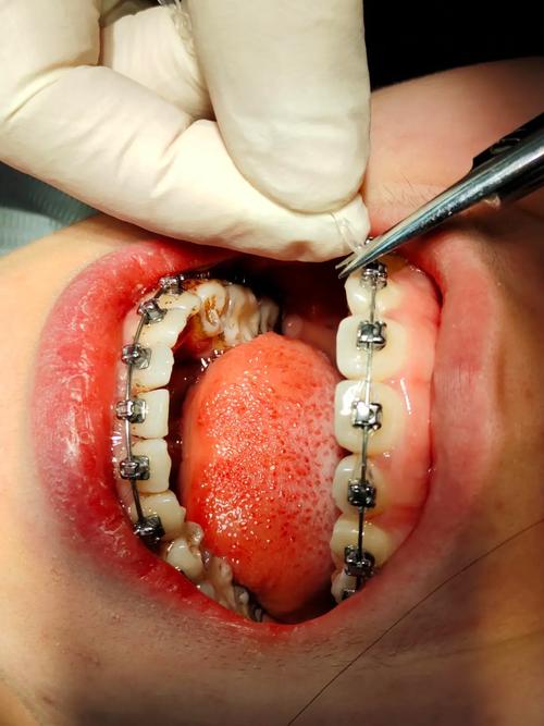 成人地包天牙齿矫正_成人地包天牙齿矫正价格_成人地包天牙齿矫正有效果吗