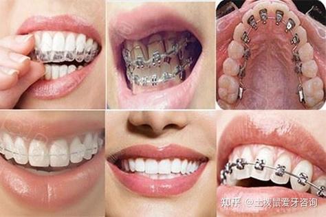 34岁能牙齿矫正吗_牙齿矫正能用医保报销吗_牙齿矫正能走医保吗