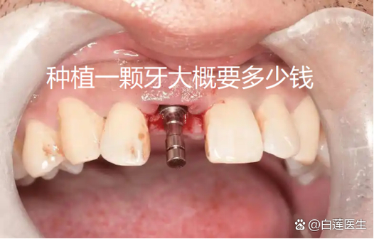 纯钛种牙的费用_种纯钛牙多少钱_纯钛的种植牙一般多少年