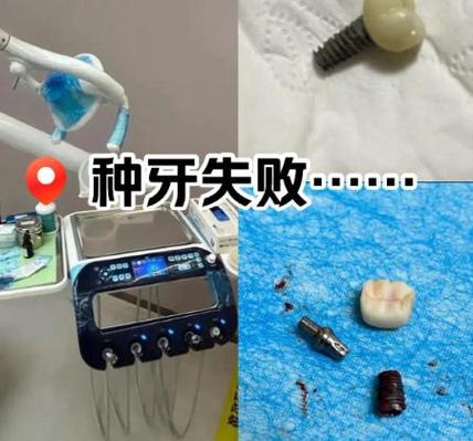 牙槽骨薄植骨_深圳牙槽骨太薄还能种植牙吗_牙槽骨种植会不会失败