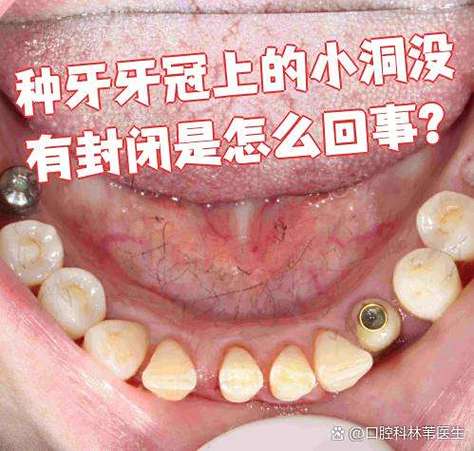 龙华医院种牙多少钱_深圳龙华种牙价格_深圳龙华全口种植牙当天装牙冠
