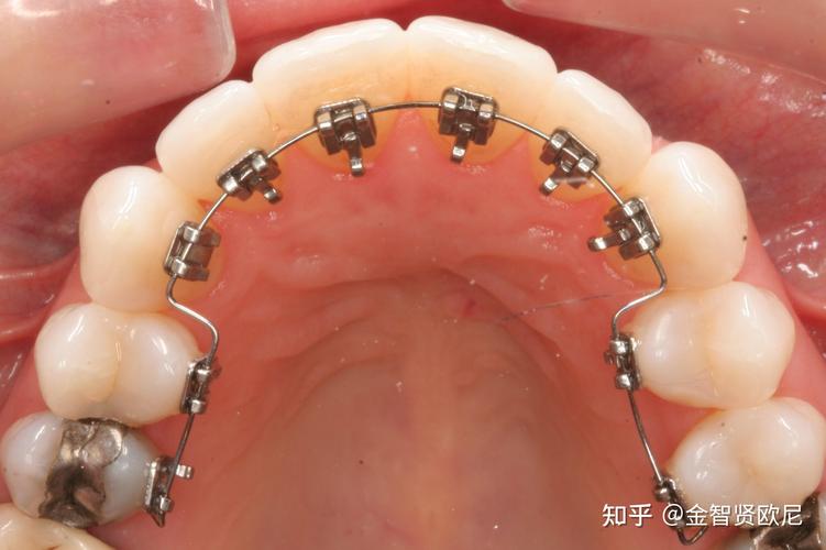 安溪哪里可以矫正牙齿_牙齿矫正可以去医院吗_牙齿矫正可以动手术吗