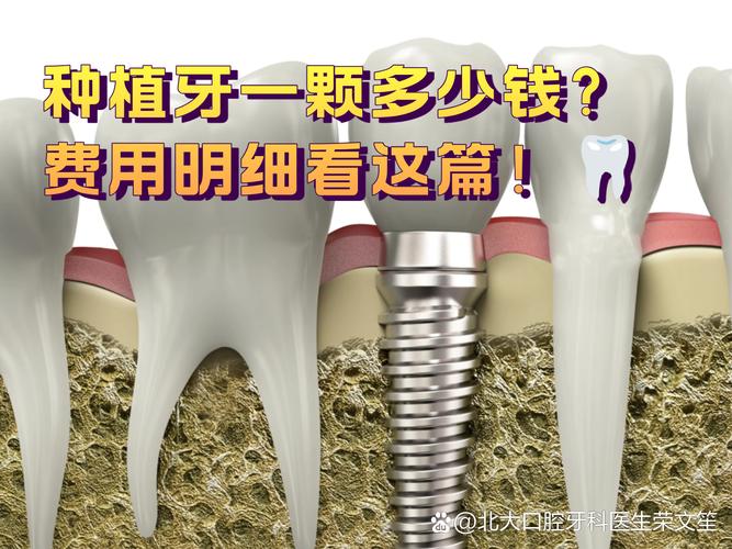2025年种牙一颗到底要花多少钱?看完这篇不踩坑