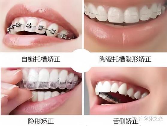牙齿矫正天津价格_天津青少年牙齿矫正_牙齿青少年矫正天津哪里好