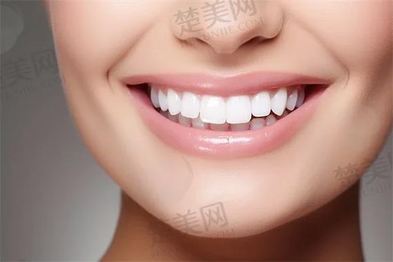杭州自锁牙齿矫正多少钱?真实费用全揭秘