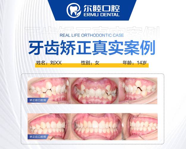 矫正报价深圳牙缝过大的医院_矫正牙齿缝隙多少钱_深圳牙缝过大矫正报价