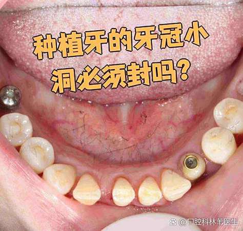深圳龙华种牙价格_龙华医院种牙多少钱_深圳龙华全口种植牙当天装牙冠