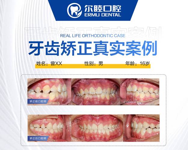 深圳福田牙医诊所排名_深圳福田隐形牙齿矫正哪家医生好_深圳隐形牙齿矫正价格