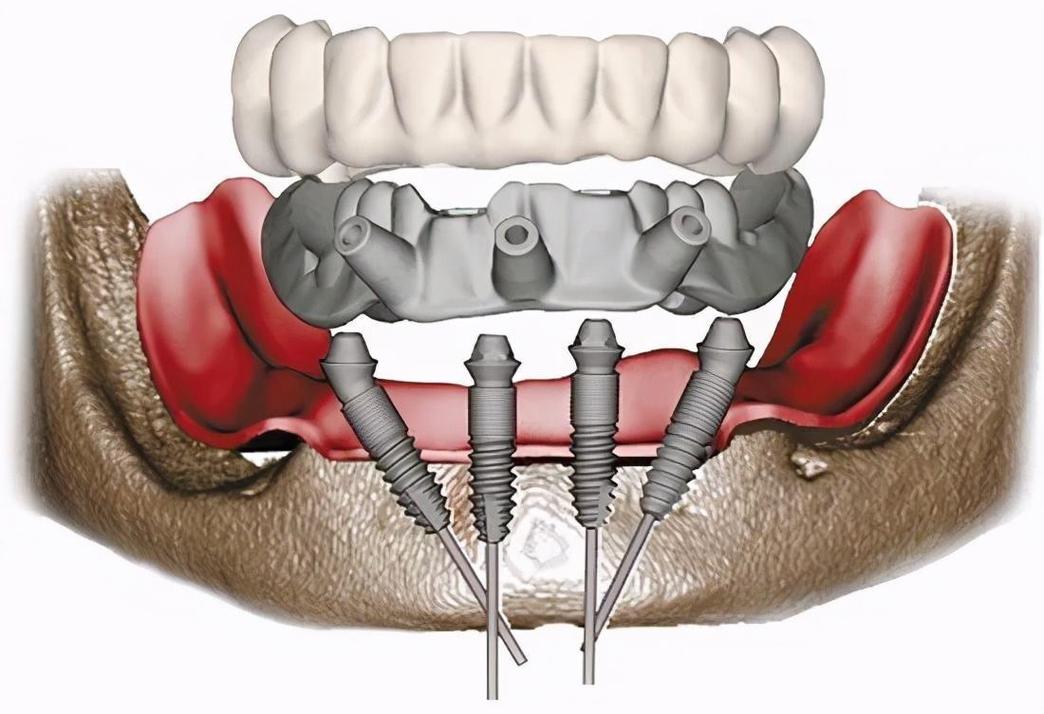 3d导板种植牙技术成熟吗_牙齿种植导板_导板种植牙视频