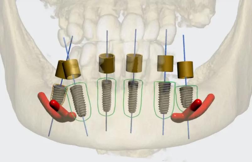 导板种植牙视频_牙齿种植导板_3d导板种植牙技术成熟吗