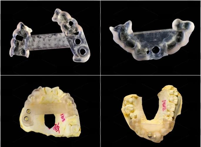 3d导板种植牙技术成熟吗_导板种植牙视频_牙齿种植导板