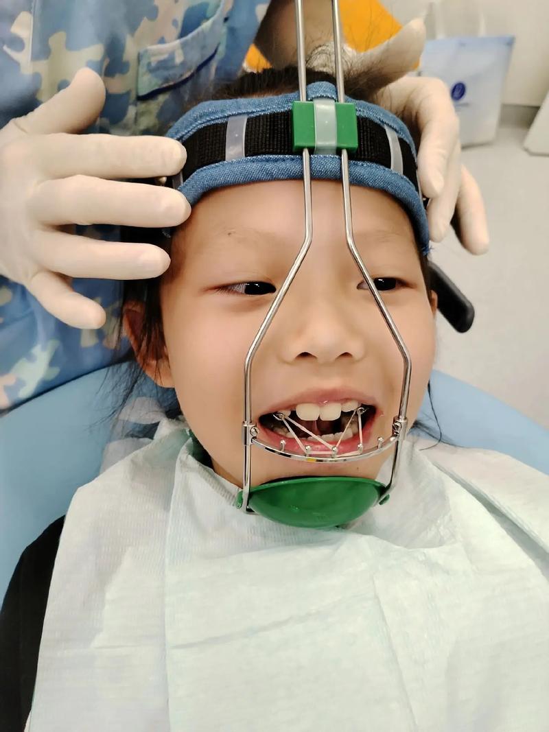 宝宝地包天矫正需要多长时间_宝宝地包天矫正_宝宝地包天牙齿怎么纠正