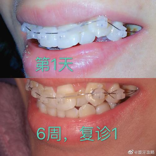 牙齿矫正牙缝大价目表_深圳牙缝过大矫正报价_矫正牙缝过大的费用是多少