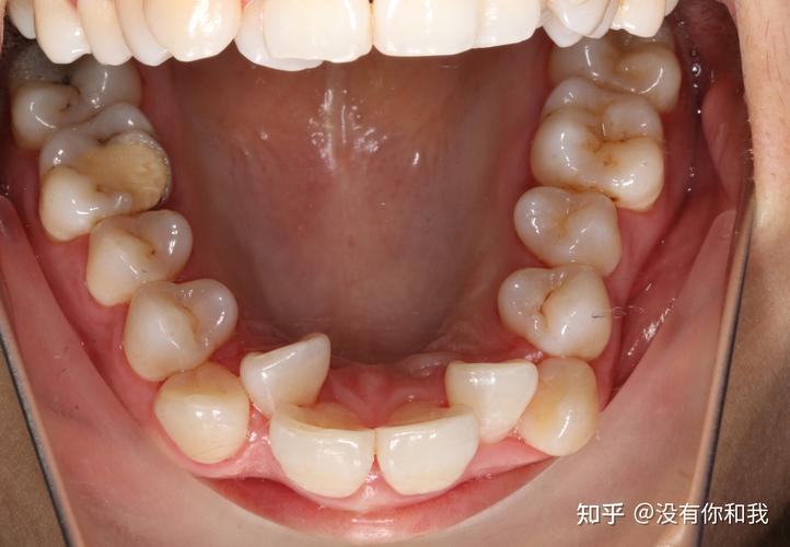 深圳30岁还能做牙齿矫正吗_在深圳矫正牙齿可以用医保吗_深圳矫正牙齿可以报社保吗