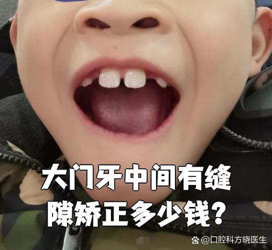 2021矫正牙齿收费价目表_西乡牙齿矫正费用_牙齿矫正大概要花费多少钱西安
