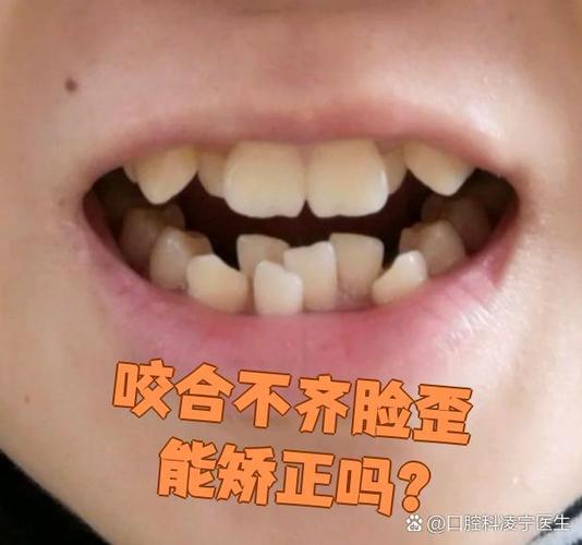 牙齿矫正齐咬合需要多久_40岁牙齿咬合不齐,需要矫正吗_正畸矫正咬合