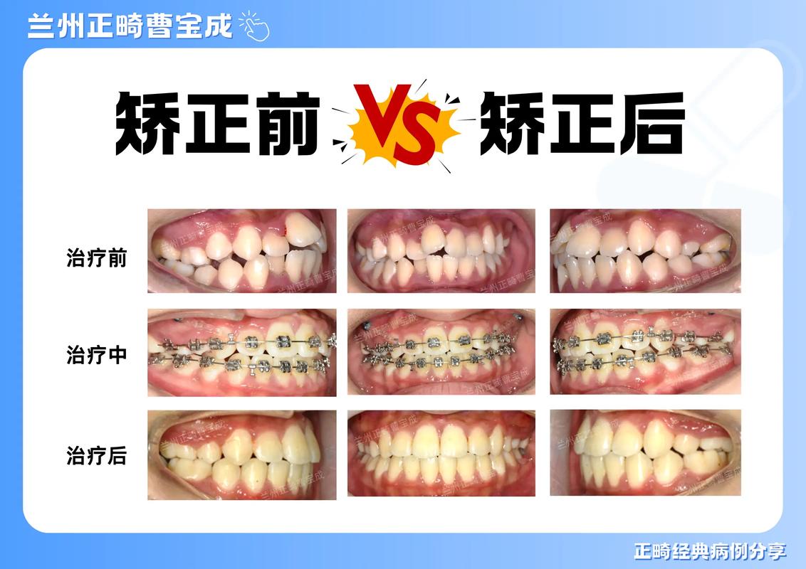 牙齿矫正利大于弊吗_牙齿矫正弊利的原因_20岁矫正牙齿的利与弊