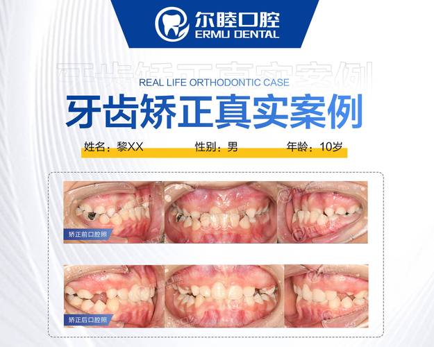 深圳龙华钢丝矫正靠谱牙科_深圳钢牙矫正_深圳龙华牙齿矫正