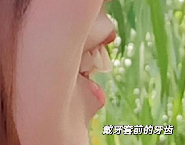 深圳骨性龅牙正畸哪家医院靠谱_深圳正畸比较好的医院_深圳最好的正畸医生排名榜