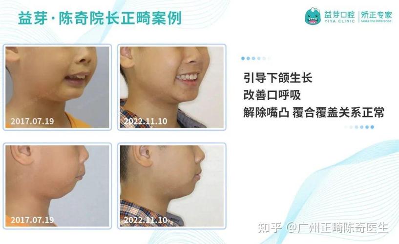 东莞儿童牙齿矫正几岁开始最好？家长别等换完牙才后悔