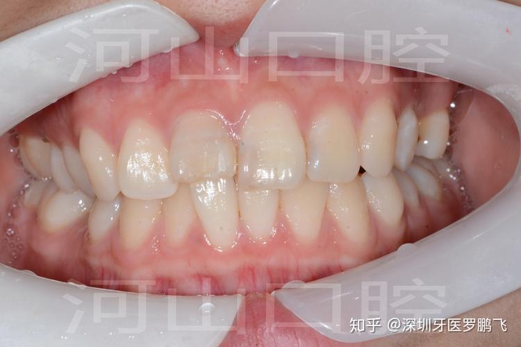 20岁牙齿还能不能矫正？成年人正畸真实情况揭秘