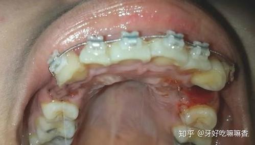 宁波青少年牙齿矫正选哪家?费用多少?看完这篇就明白