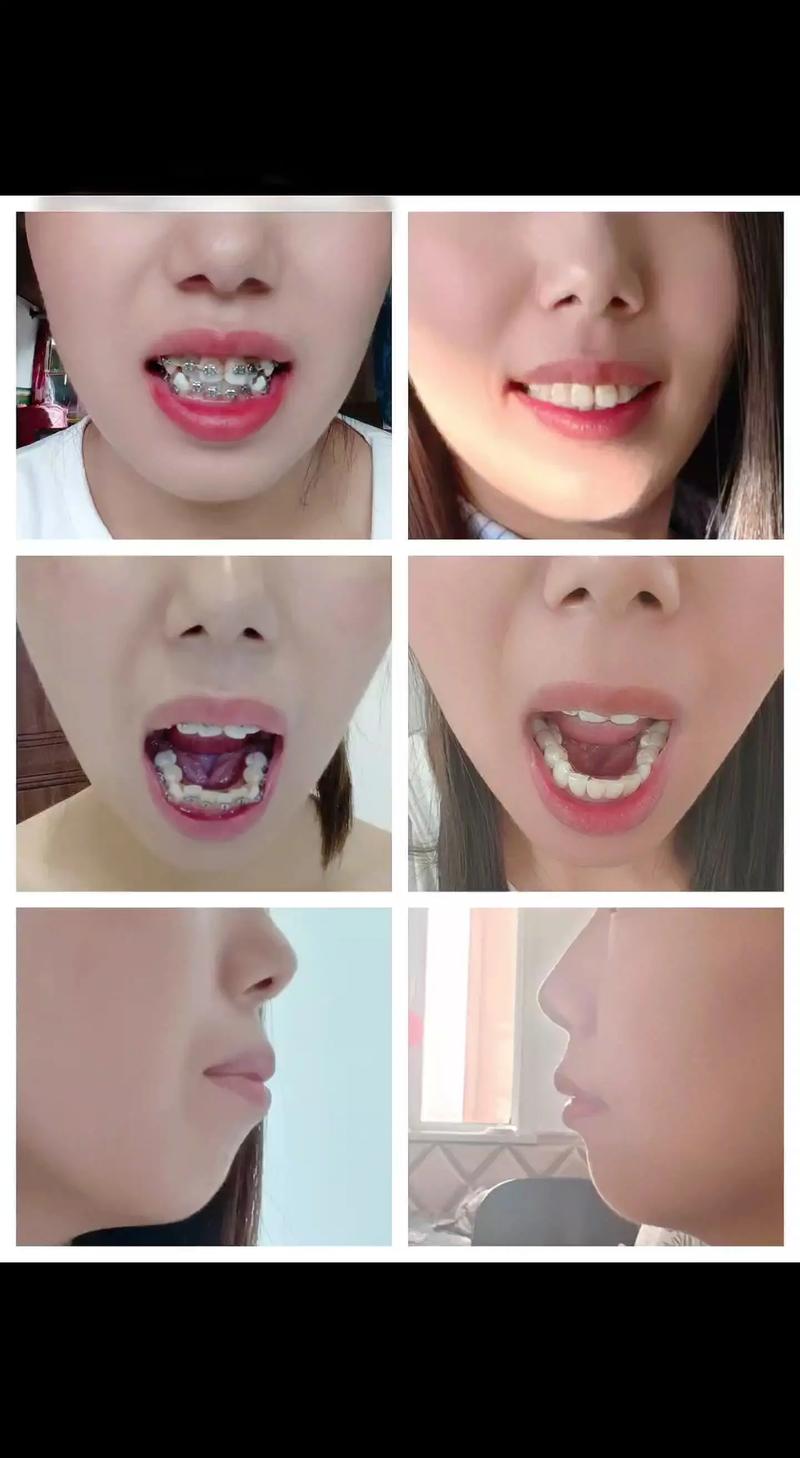 牙齿矫正做哪种好_35岁做牙齿矫正_牙齿矫正做一半能放弃吗