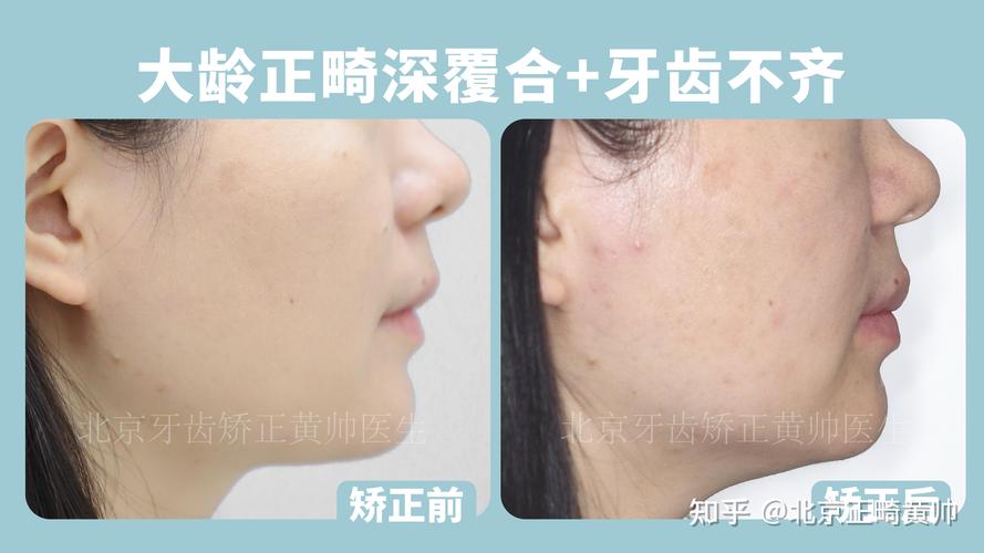 覆盖牙齿矫正_矫正覆合牙套多少钱_45岁矫正深覆合牙齿要多少钱