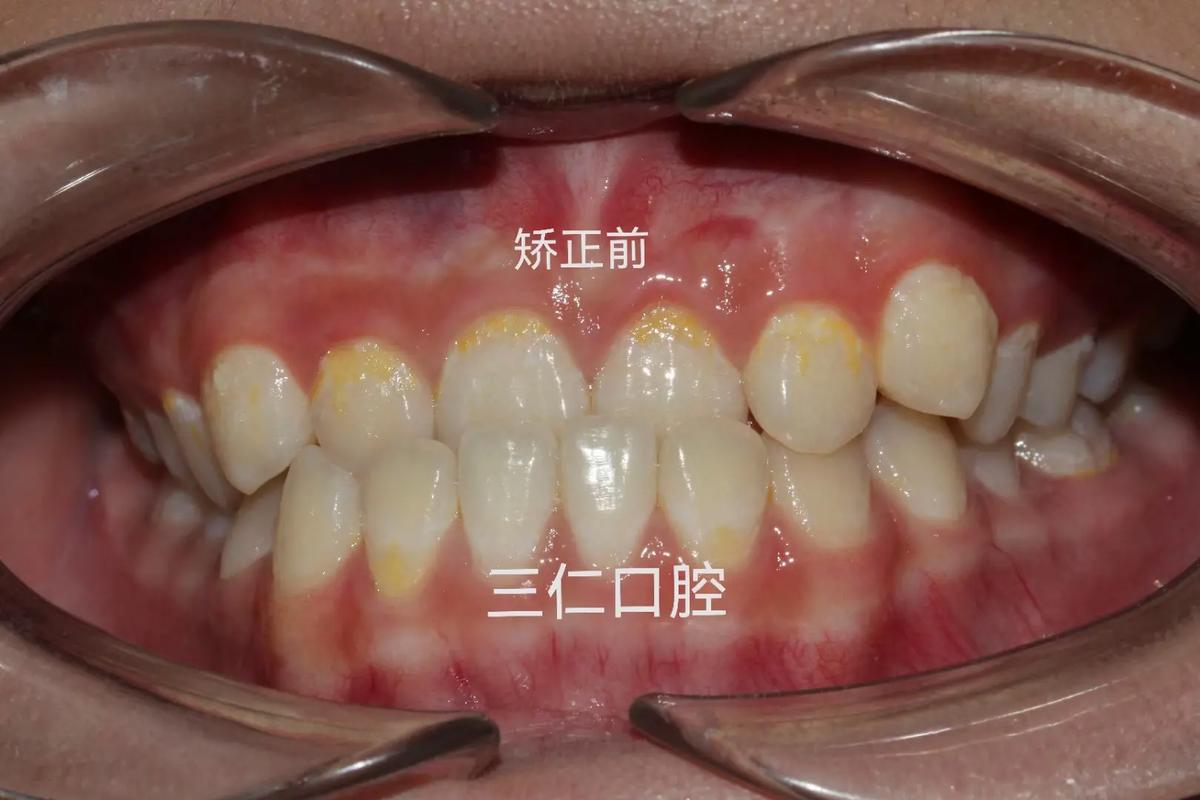 矫正牙齿地包天_矫正牙齿地包天一般要花多少钱_地包天的牙齿要矫正