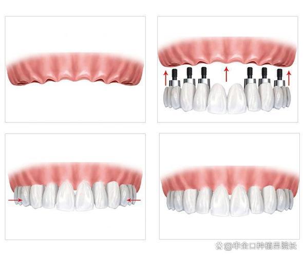 深圳宝安中老年半口种牙价格_深圳宝安牙科医院哪家好_宝安口腔种牙哪家口碑最好