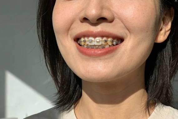 北京牙齿矫正费用揭秘:2026年一般要花多少钱?