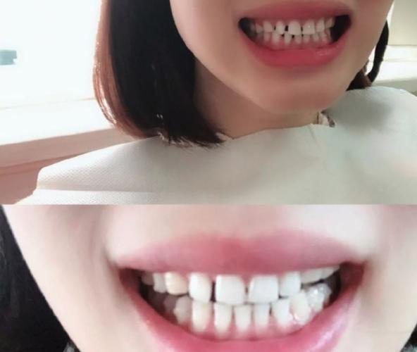 成都钢丝矫正牙齿要多少钱?真实价格全曝光