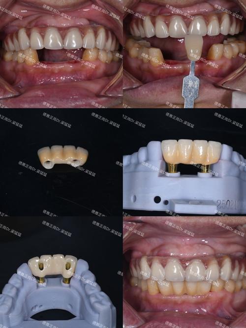 牙齿种植可以用多久_牙齿可以种植真的吗_牙齿种植可以用医保吗