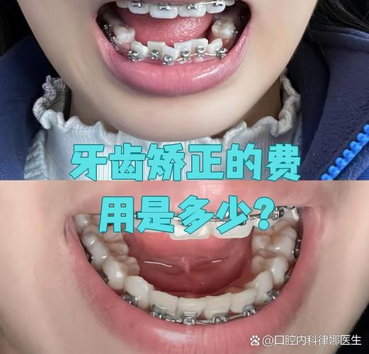 矫正爆牙_暴牙矫正的最佳年龄_暴牙齿矫正需多长时间