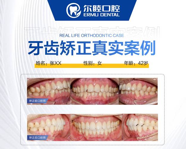 牙齿矫正牙缝大价目表_深圳牙缝过大矫正报价_矫正报价深圳牙缝过大的医院